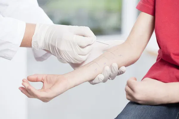 TESTE DE ALERGIA